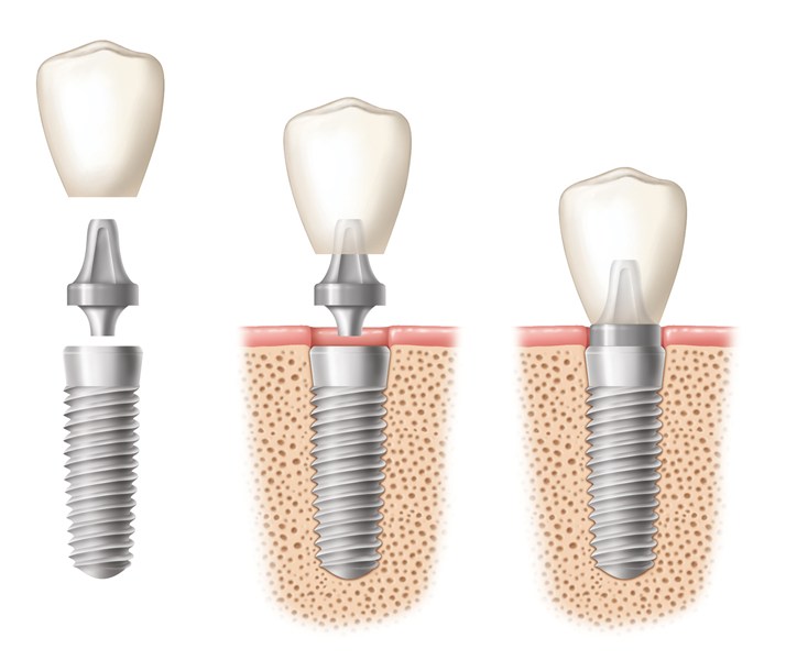 dental-implant